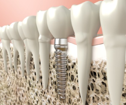 Bone Grafting for Dental Implants