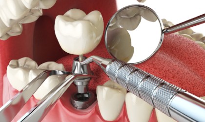 Dental Implant Technology, Sexsmith Dentist